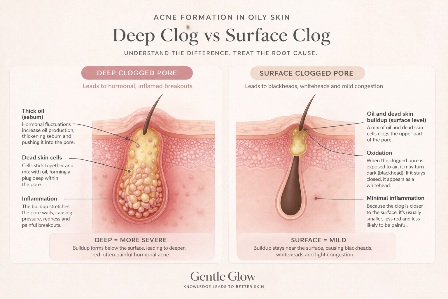 Deep vs surface acne formation showing oil and dead skin buildup inside the pore on oily skin