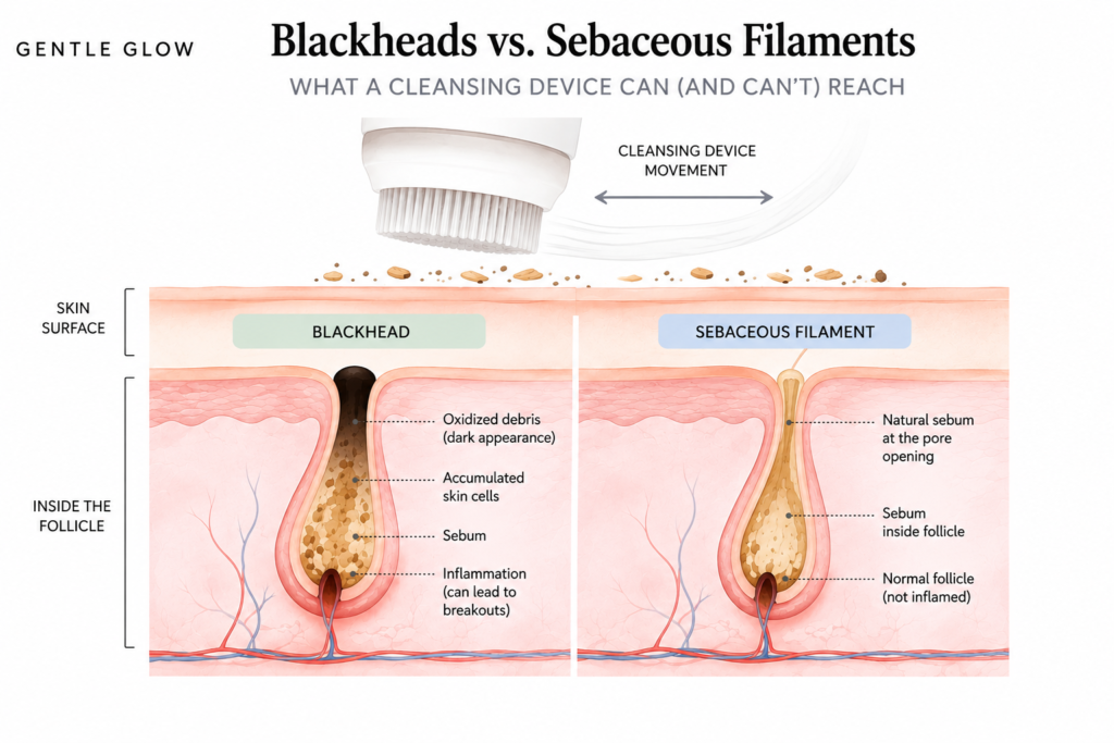 Blackheads vs sebaceous filaments infographic showing what a cleansing device can reach at the skin surface and what remains inside the follicle.