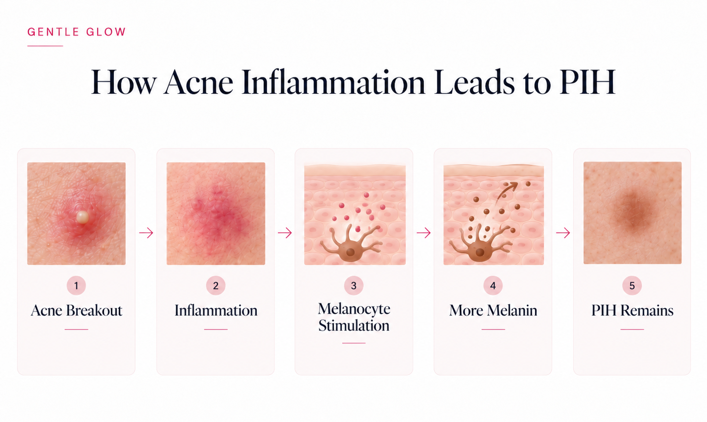 Infographic showing how acne inflammation leads to post-acne hyperpigmentation, from acne breakout to PIH.