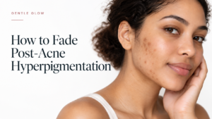 Woman with post-acne hyperpigmentation marks on her cheek and jawline for Gentle Glow’s guide to fading PIH.