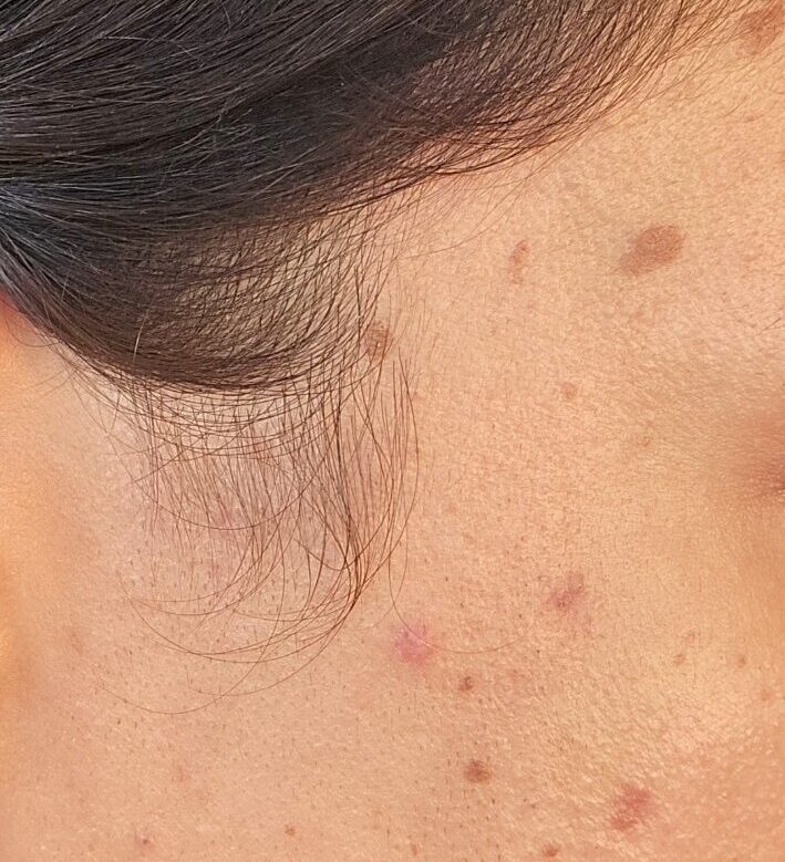 Real-life close-up showing brown post-acne marks and active breakouts on the cheek.
